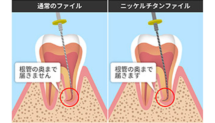 Ni-Ti（ニッケルチタン）ファイルの使用